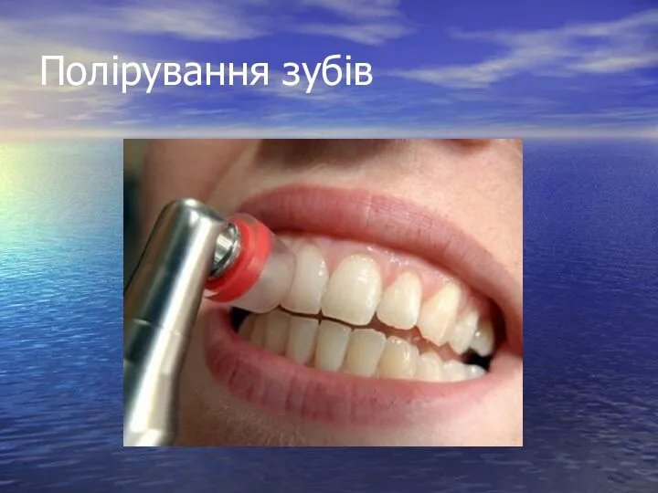 Полірування зубів