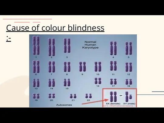 Cause of colour blindness :-