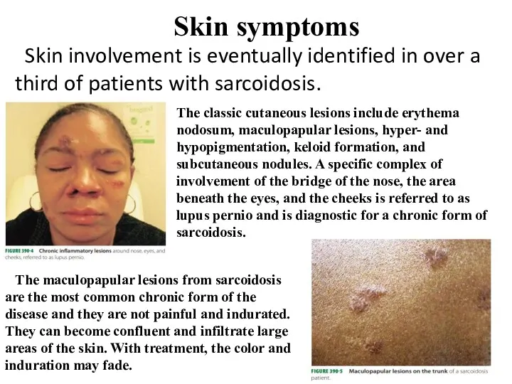 Skin symptoms Skin involvement is eventually identified in over a