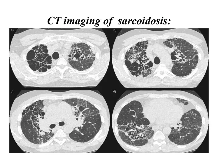 CT imaging of sarcoidosis: