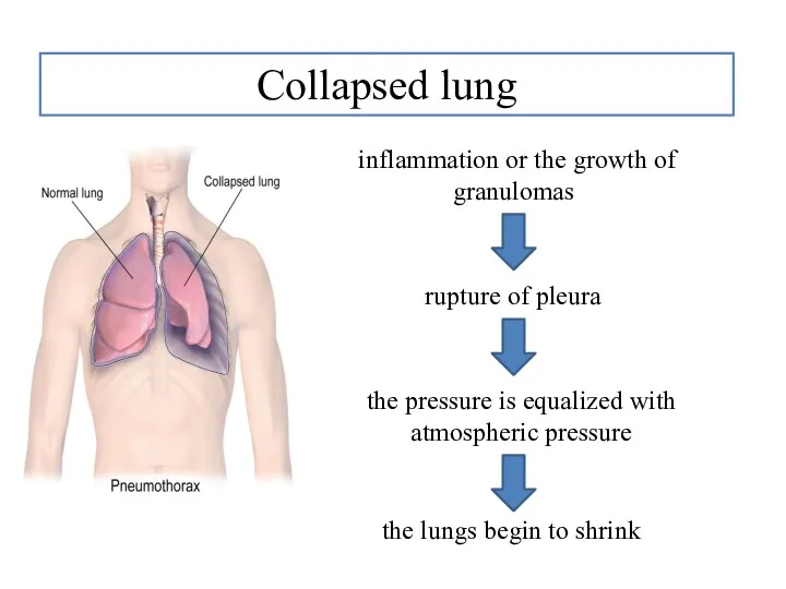 Collapsed lung inflammation or the growth of granulomas rupture of