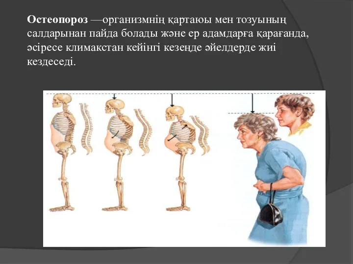 Остеопороз —организмнің қартаюы мен тозуының салдарынан пайда болады және ер