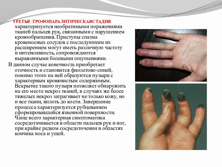 ТРЕТЬЯ ТРОФОПАРАЛИТИЧЕСКАЯСТАДИЯ характеризуется необратимыми поражениями тканей пальцев рук, связанными с