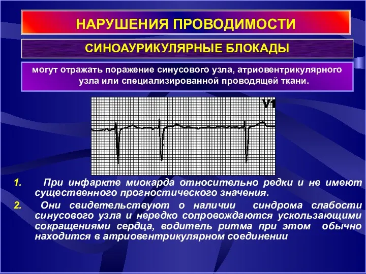 НАРУШЕНИЯ ПРОВОДИМОСТИ могут отражать поражение синусового узла, атриовентрикулярного узла или специализированной проводящей ткани.