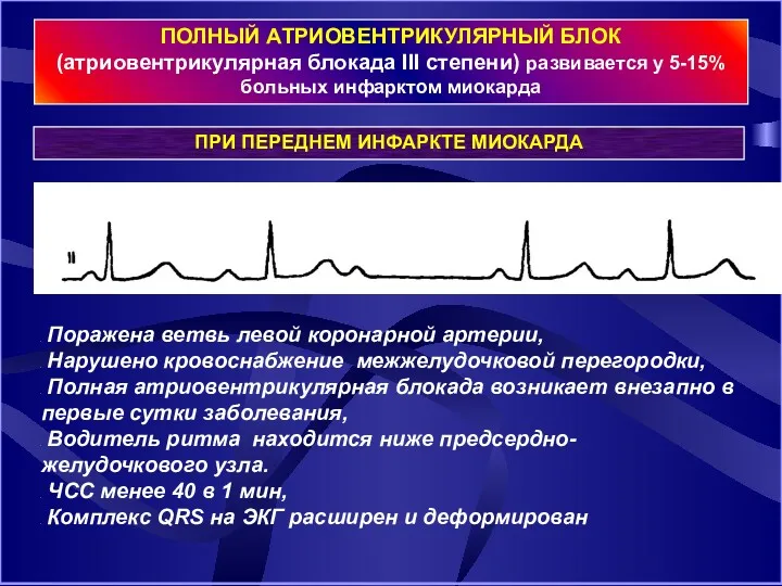 ПОЛНЫЙ АТРИОВЕНТРИКУЛЯРНЫЙ БЛОК (атриовентрикулярная блокада III степени) развивается у 5-15% больных инфарктом миокарда