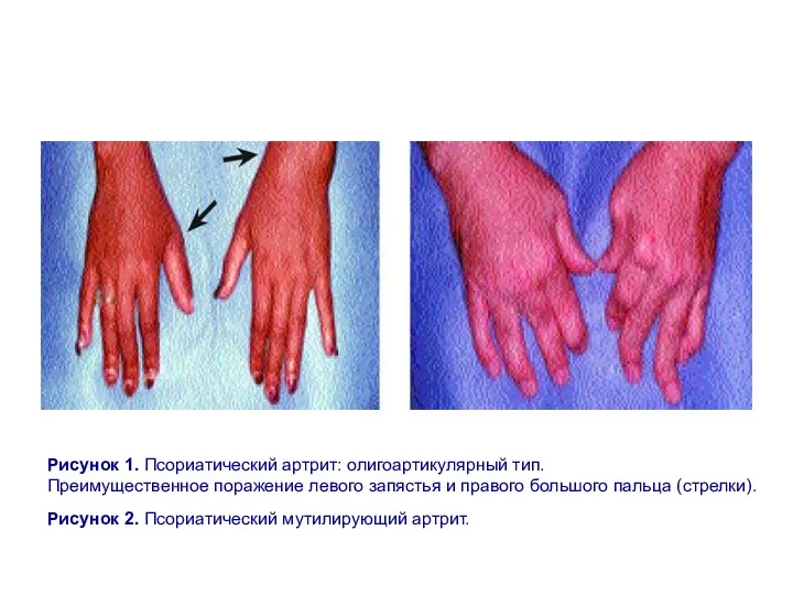 Рисунок 1. Псориатический артрит: олигоартикулярный тип. Преимущественное поражение левого запястья