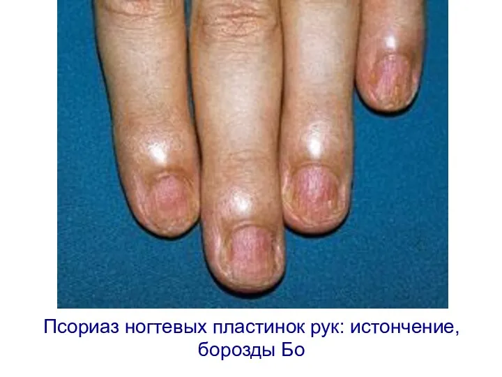 Псориаз ногтевых пластинок рук: истончение, борозды Бо