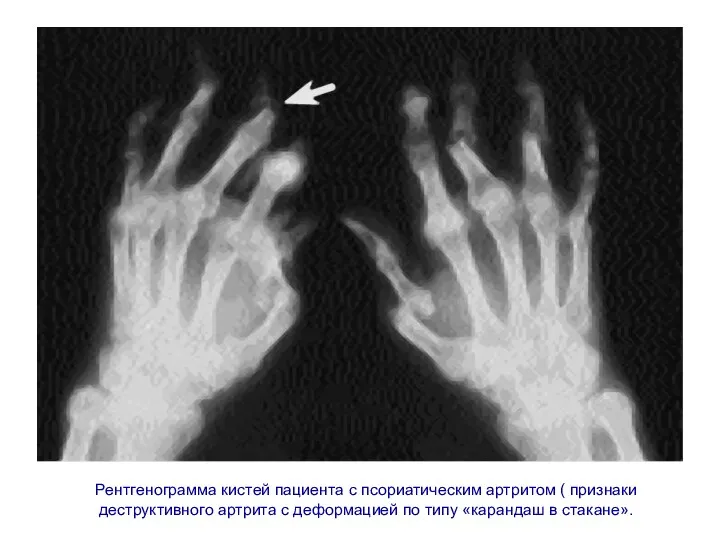 Рентгенограмма кистей пациента с псориатическим артритом ( признаки деструктивного артрита
