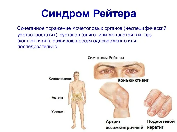 Синдром Рейтера Сочетанное поражение мочеполовых органов (неспецифический уретропростатит), суставов (олиго-