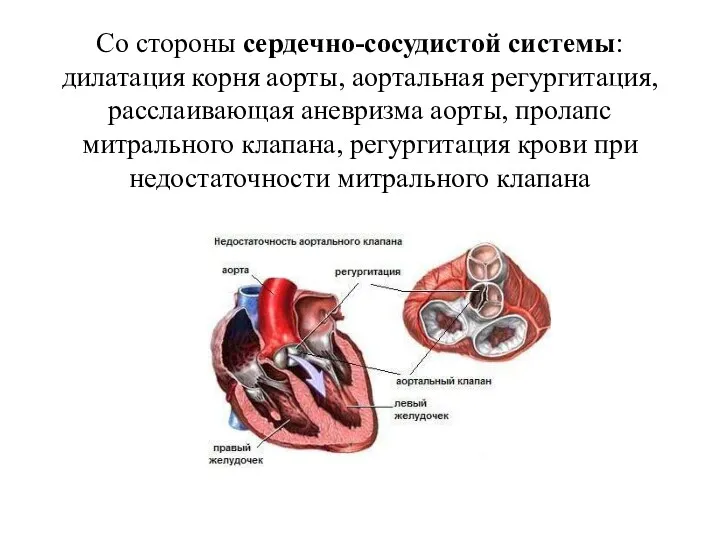 Со стороны сердечно-сосудистой системы: дилатация корня аорты, аортальная регургитация, расслаивающая