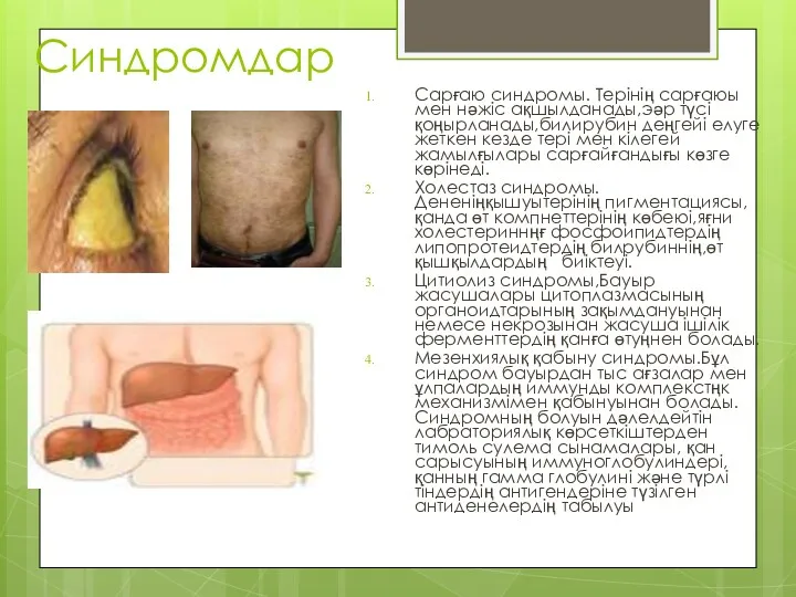 Синдромдар Сарғаю синдромы. Терінің сарғаюы мен нәжіс ақшылданады,эәр түсі қоңырланады,билирубин