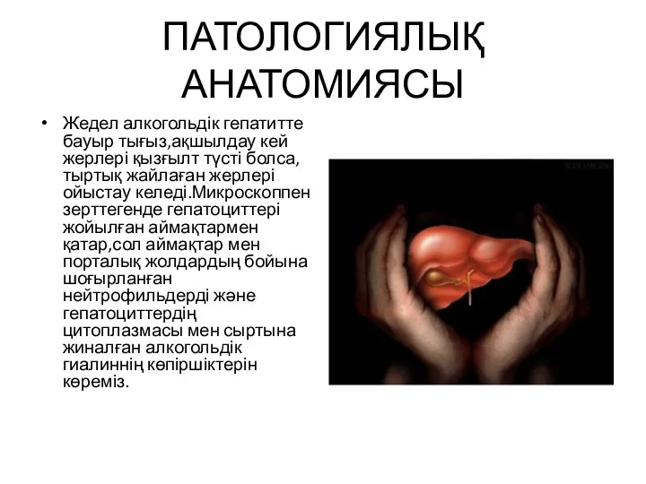 ПАТОЛОГИЯЛЫҚ АНАТОМИЯСЫ Жедел алкогольдік гепатитте бауыр тығыз,ақшылдау кей жерлері қызғылт