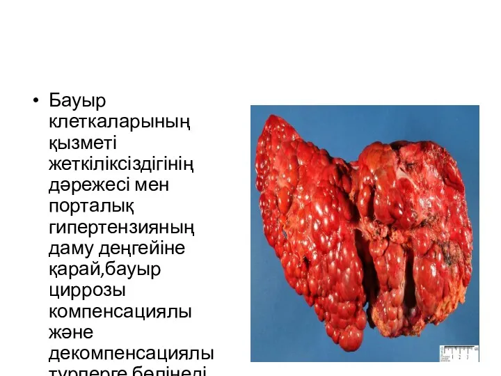 Бауыр клеткаларының қызметі жеткіліксіздігінің дәрежесі мен порталық гипертензияның даму деңгейіне