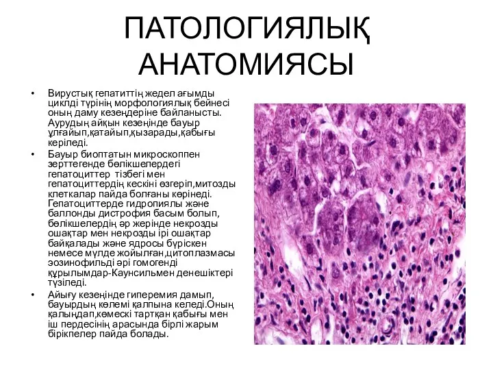 ПАТОЛОГИЯЛЫҚ АНАТОМИЯСЫ Вирустық гепатиттің жедел ағымды циклді түрінің морфологиялық бейнесі