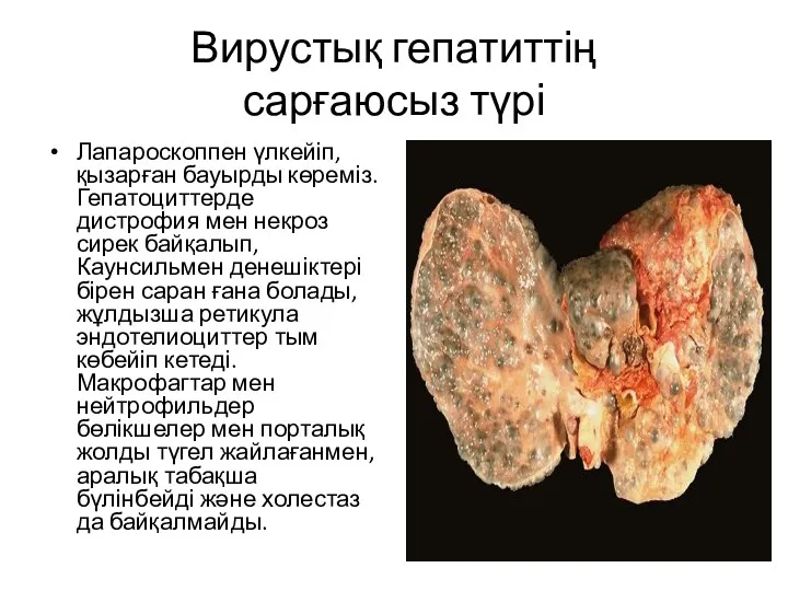 Вирустық гепатиттің сарғаюсыз түрі Лапароскоппен үлкейіп,қызарған бауырды көреміз.Гепатоциттерде дистрофия мен