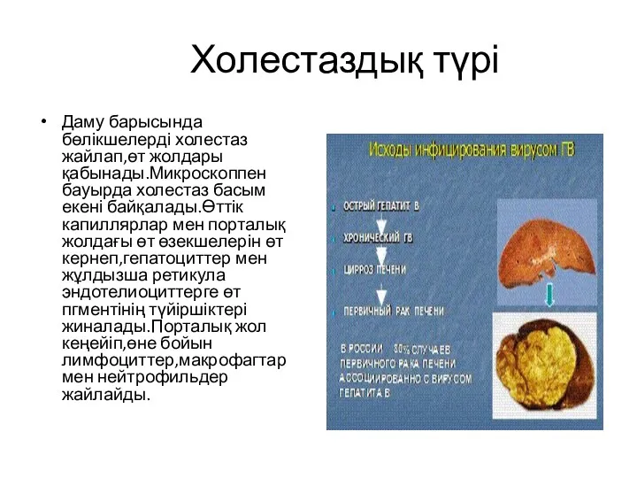 Холестаздық түрі Даму барысында бөлікшелерді холестаз жайлап,өт жолдары қабынады.Микроскоппен бауырда холестаз басым екені