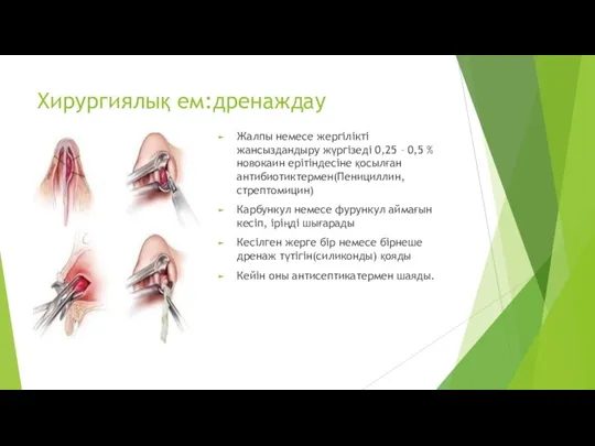 Хирургиялық ем:дренаждау Жалпы немесе жергілікті жансыздандыру жүргізеді 0,25 – 0,5