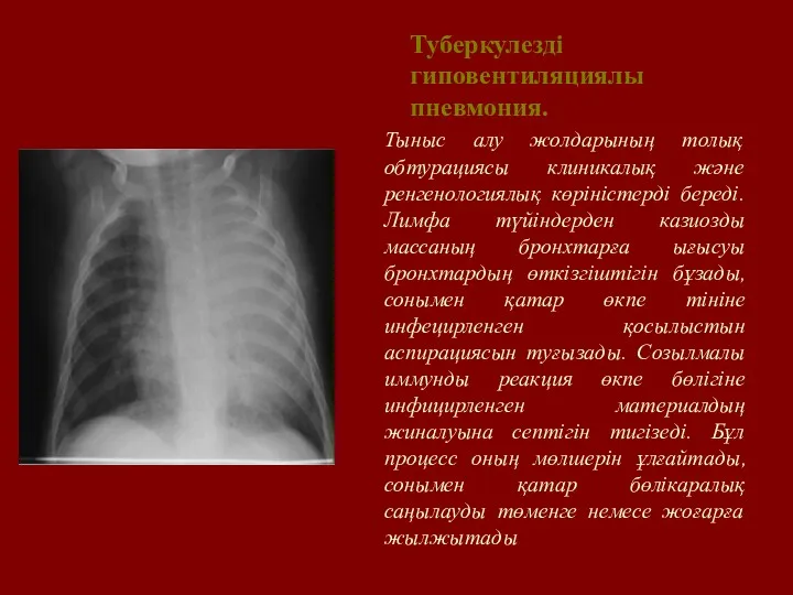 Туберкулезді гиповентиляциялы пневмония. Тыныс алу жолдарының толық обтурациясы клиникалық және ренгенологиялық көріністерді береді.