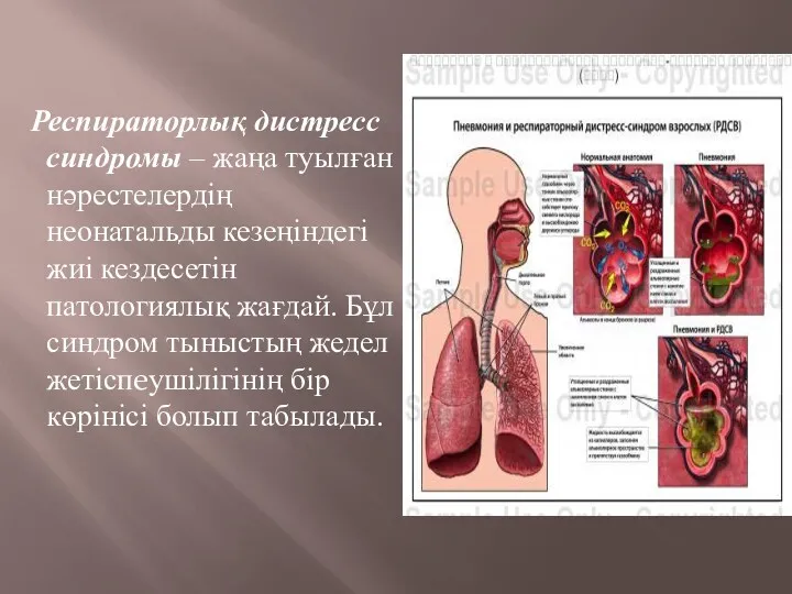 Респираторлық дистресс синдромы – жаңа туылған нәрестелердің неонатальды кезеңіндегі жиі