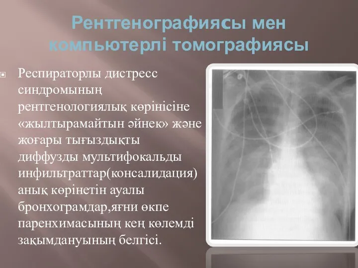 Рентгенографияcы мен компьютерлі томографиясы Респираторлы дистресс синдромының рентгенологиялық көрінісіне «жылтырамайтын