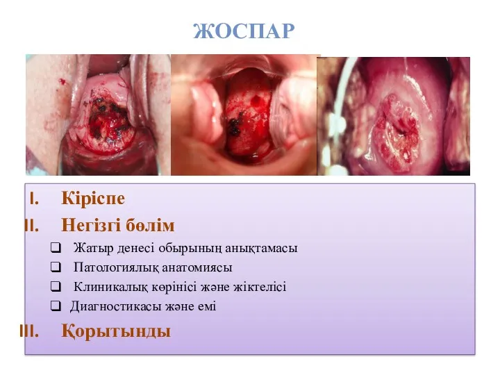 ЖОСПАР Кіріспе Негізгі бөлім Жатыр денесі обырының анықтамасы Патологиялық анатомиясы Клиникалық көрінісі және