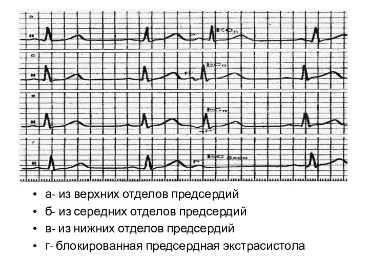 а- из верхних отделов предсердий б- из середних отделов предсердий