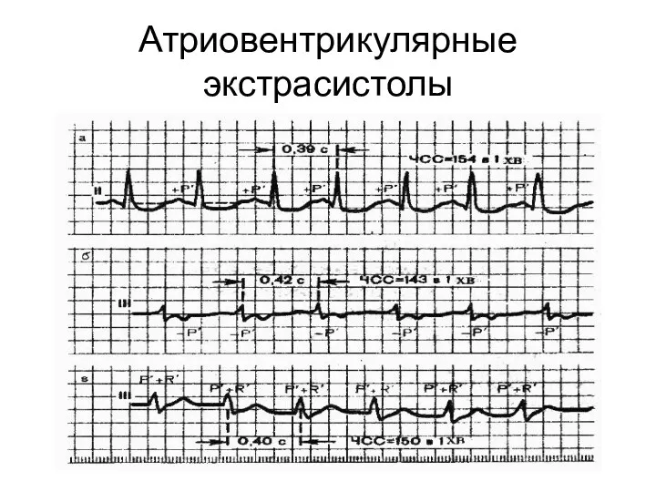 Атриовентрикулярные экстрасистолы