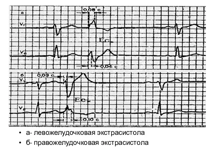 а- левожелудочковая экстрасистола б- правожелудочковая экстрасистола