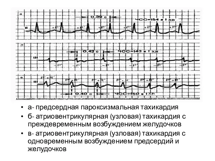 а- предсердная пароксизмальная тахикардия б- атриовентрикулярная (узловая) тахикардия с преждевременным