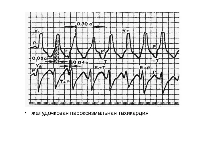 желудочковая пароксизмальная тахикардия