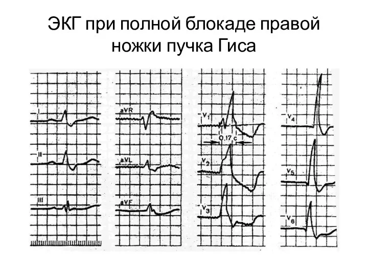 ЭКГ при полной блокаде правой ножки пучка Гиса