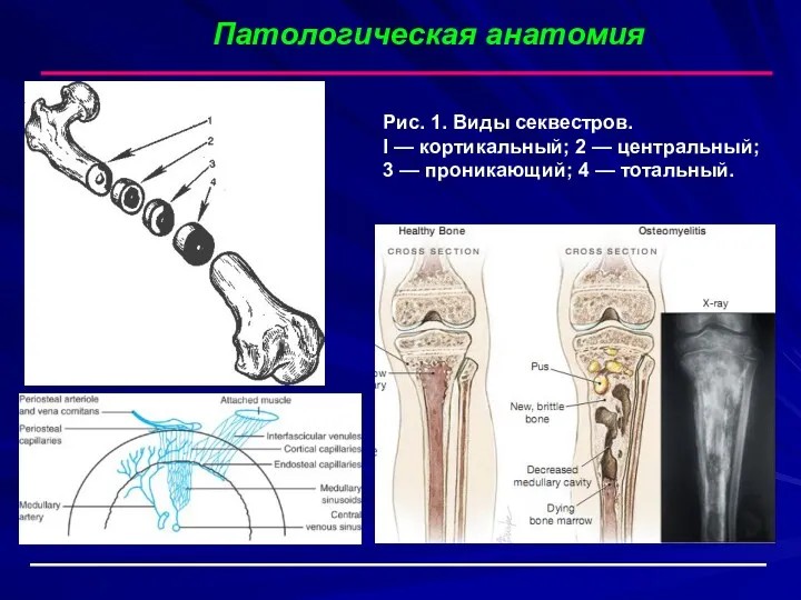 Патологическая анатомия Рис. 1. Виды секвестров. I — кортикальный; 2