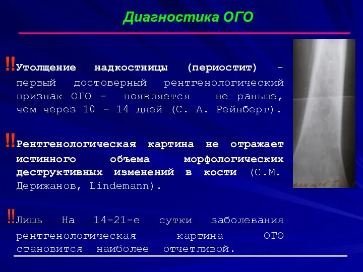 Диагностика ОГО Утолщение надкостницы (периостит) - первый достоверный рентгенологический признак ОГО - появляется