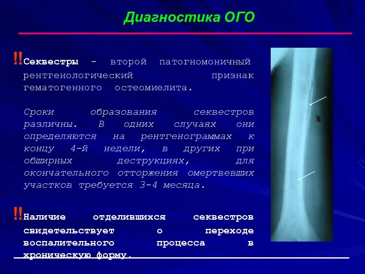 Диагностика ОГО Секвестры - второй патогномоничный рентгенологический признак гематогенного остеомиелита.