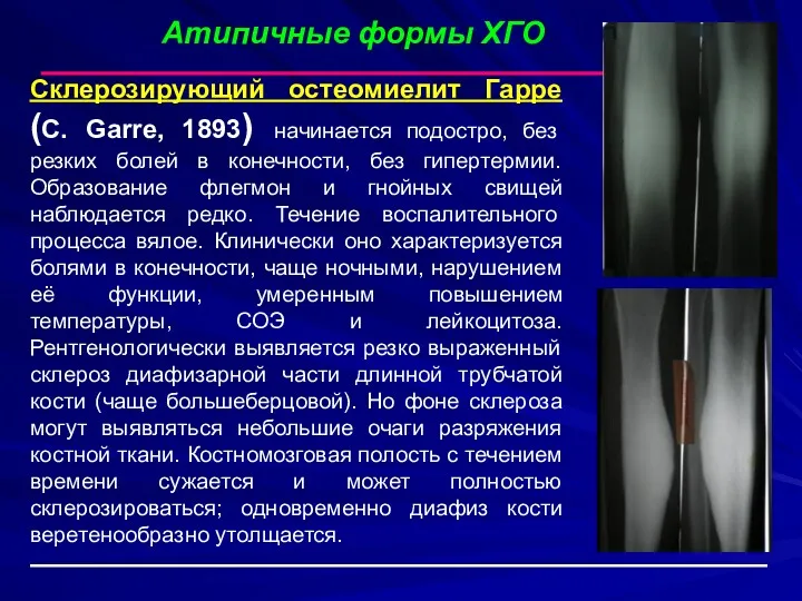 Склерозирующий остеомиелит Гарре (С. Garre, 1893) начинается подостро, без резких болей в конечности,