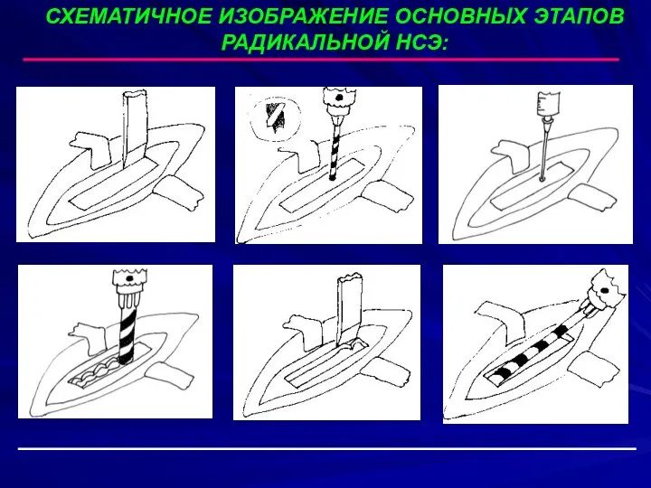 СХЕМАТИЧНОЕ ИЗОБРАЖЕНИЕ ОСНОВНЫХ ЭТАПОВ РАДИКАЛЬНОЙ НСЭ: