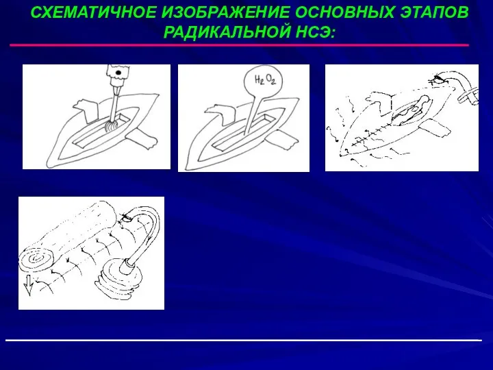 СХЕМАТИЧНОЕ ИЗОБРАЖЕНИЕ ОСНОВНЫХ ЭТАПОВ РАДИКАЛЬНОЙ НСЭ: