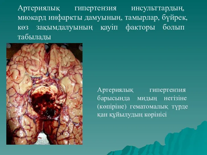 Артериялық гипертензия инсульттардың, миокард инфаркты дамуының, тамырлар, бүйрек, көз зақымдалуының қауіп факторы болып