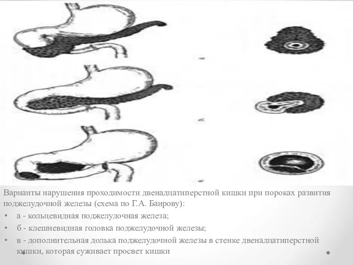 Варианты нарушения проходимости двенадцатиперстной кишки при пороках развития поджелудочной железы