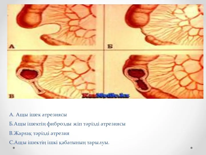 А. Ащы ішек атрезиясы Б.Ащы ішектің фиброзды жіп тәрізді атрезиясы