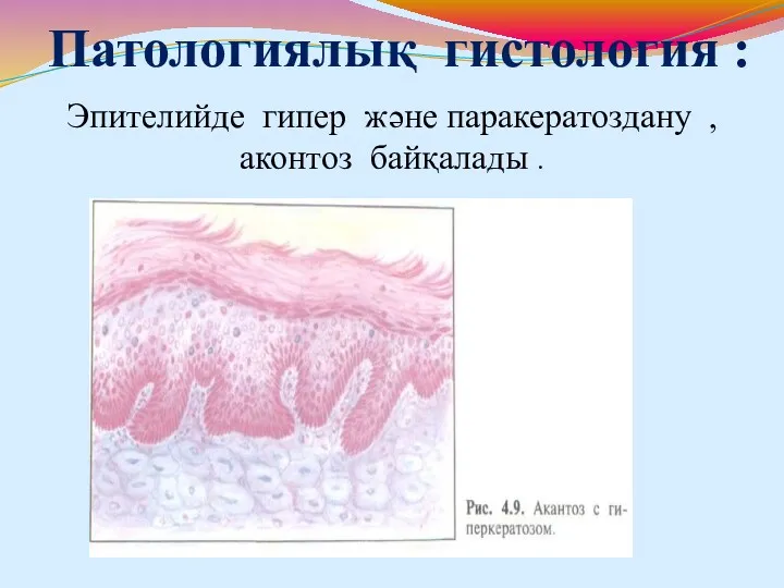 Патологиялық гистология : Эпителийде гипер және паракератоздану , аконтоз байқалады .