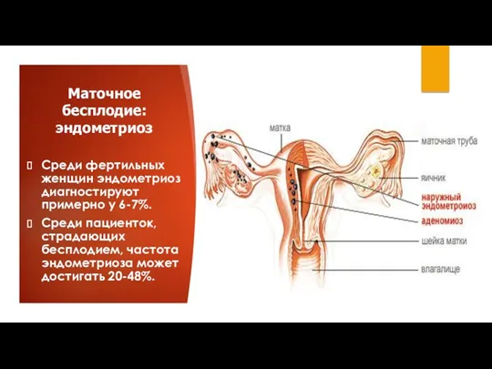 Маточное бесплодие: эндометриоз Среди фертильных женщин эндометриоз диагностируют примерно у