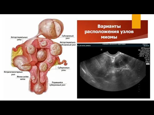 Варианты расположения узлов миомы