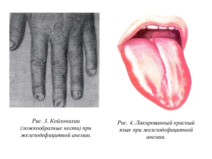 Рис. 3. Койлонихии (ложкообразные ногти) при железодефицитной анемии. Рис. 4. Лакированный красный язык при железодефицитной анемии.