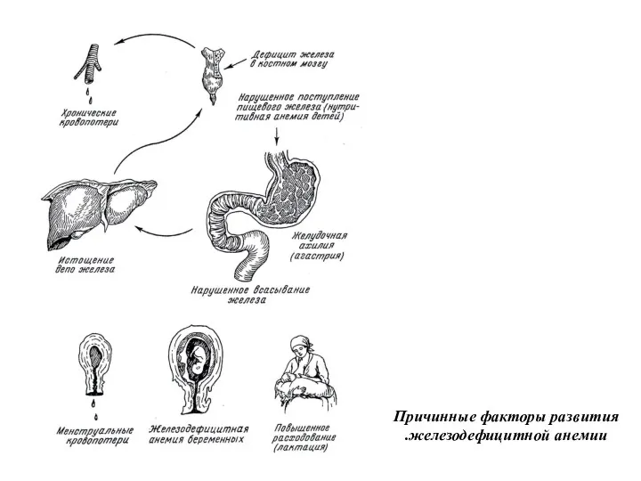 Причинные факторы развития железодефицитной анемии.