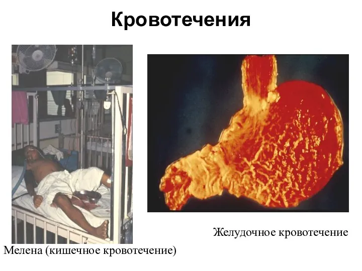 Мелена (кишечное кровотечение) Желудочное кровотечение Кровотечения