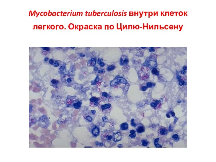 Mycobacterium tuberculosis внутри клеток легкого. Окраска по Цилю-Нильсену