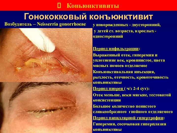 Гонококковый конъюнктивит Коньюнктивиты Возбудитель – Neisserria gonorrhoeae у новорожденных -