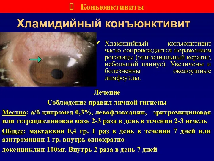 Хламидийный конъюнктивит Хламидийный конъюнктивит часто сопровождается поражением роговицы (эпителиальный кератит,