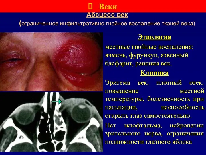 Абсцесс век (ограниченное инфильтративно-гнойное воспаление тканей века) Этиология местные гнойные